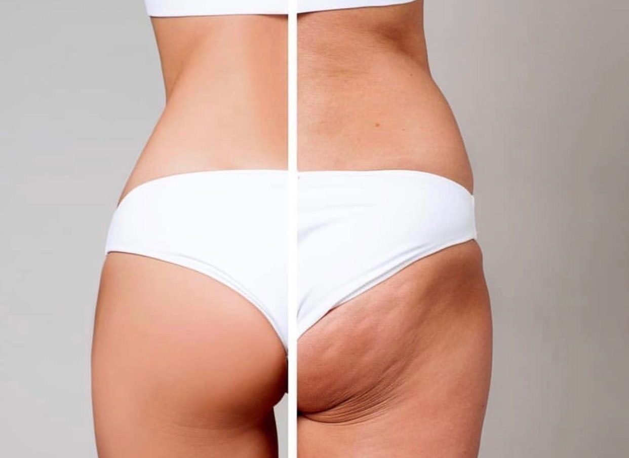 αρθρο cellulaze