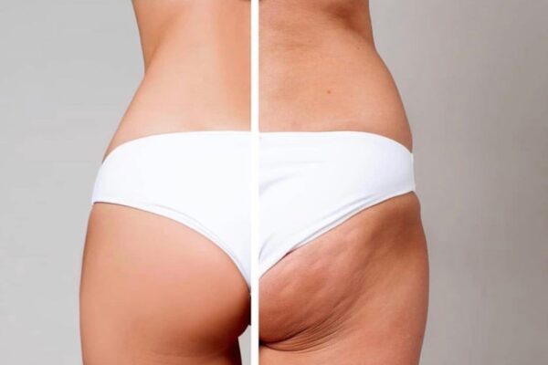 αρθρο cellulaze