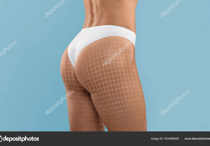 Cellulite Mesotherapy. Cropped Shot Of Perfect Female Buttocks With Drawn Mesh On It, Unrecognizable Slim Woman In White Panties Standing Isolated Over Blue Background, Collage With Copy Space